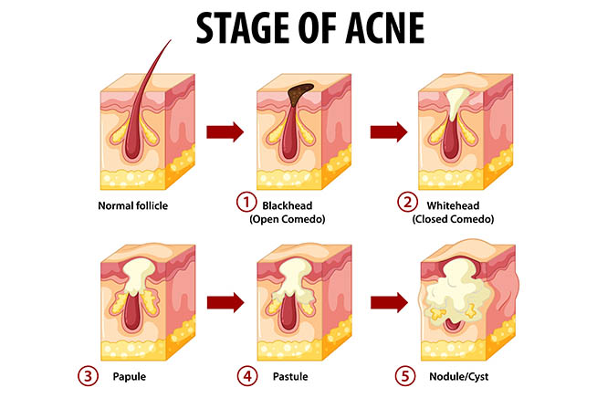 image of different stages in acne for elhawag article